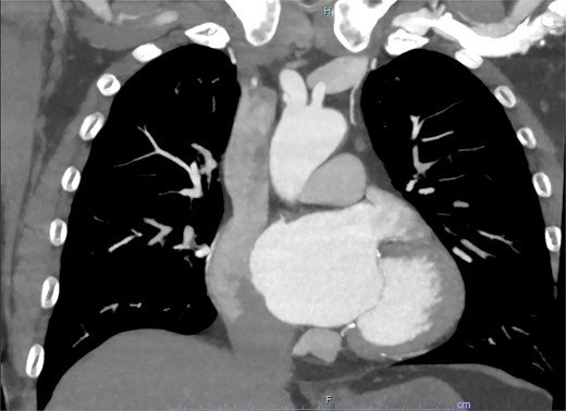 Coronal slice from CT aortogram demonstrating the origin of the dissection flap.
