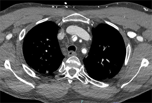 Axial slice from CT aortogram demonstrating the proximal aspect of the dissection flap.