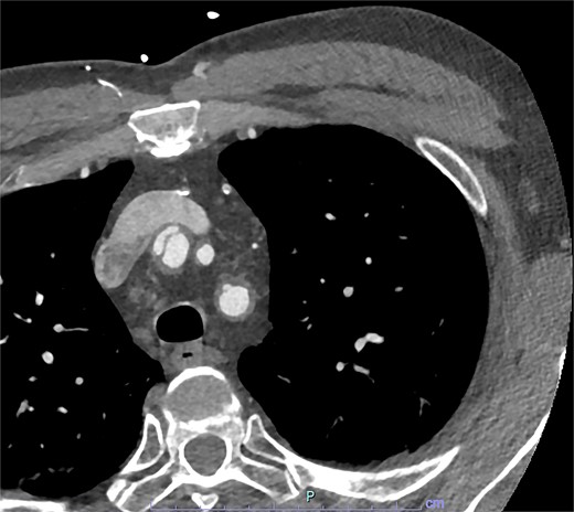 Axial slice from CT aortogram in greater detail of the dissection flap.