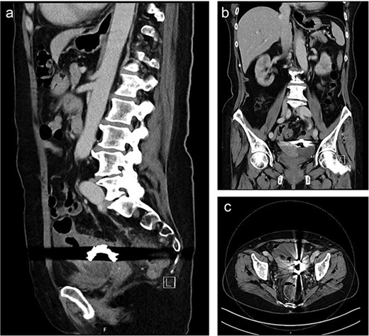 Sagittal (a), coronal (b) and axial slice (c) of a preoperative CT scan showing the ingested denture in the sigmoid colon with adjacent fluid collection and vesical air inclusions.