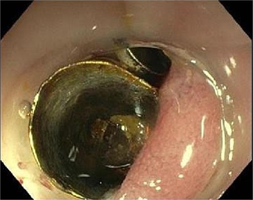 Endoscopic view showing the metal denture at 35 cm from anal verge with swollen and scarred stenosis of the sigmoid colon.
