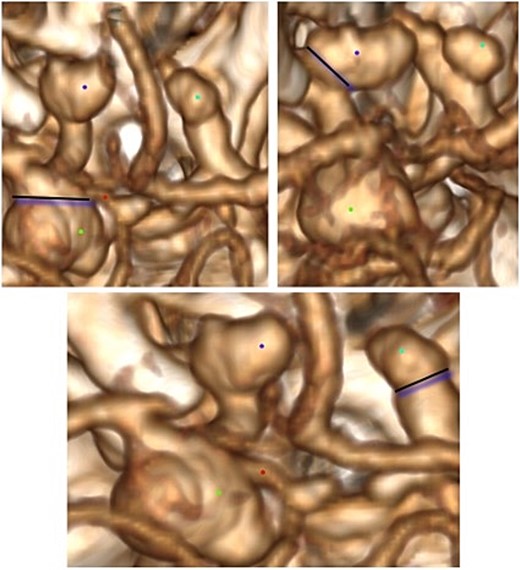 Three-dimensional imaging reconstruction of the circle of Willis from a superior view. Bilateral ophthalmic aneurysms are marked in blue, and the dysmorphic posterior communicating aneurysm is labeled in green.