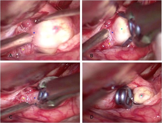 Intraoperative findings. (A) Dissection of the saccular ophthalmic aneurysm (light blue) emerging from the internal carotid artery (yellow). (B, C) A 7-mm straight clip was placed at the aneurysm neck (blue). (D) Final configuration of the aneurysm clip.
