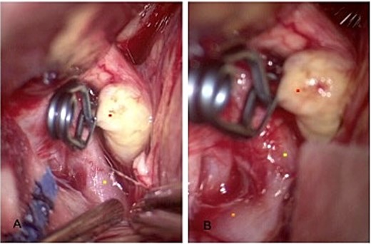 Revision of the surrounding anatomy. (A) The left communicating segment of the internal carotid is shown with the aneurysm adequately clipped. (B) The ipsilateral dysmorphic posterior communicating aneurysm came into view.