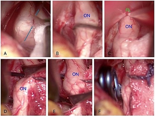 Intraoperative findings. (A) Dissection of the contralateral sylvian fissure (sky-blue line). (B) Dissection of the contralateral optic nerve (ON). (C) Dissection of the falciform ligament (FL). (D) Identification of the right ophthalmic aneurysm neck (brown) and contralateral ophthalmic artery (green). (E) Visualization of the inferior part of the aneurysm neck (orange) and perforating arteries. (F) Placement of the 9 mm semi-curved clip.