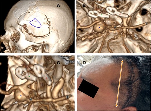 Postoperative imaging and course. (A) Left frontotemporal craniotomy (purple). (B) Postoperative three-dimensional computed tomography angiography showed adequate clip placement. (C) 7 mm straight clip (green), 9 mm semi-curved clip (red). (D) Wound without signs of infection or edema.