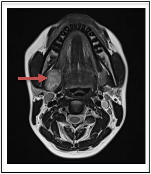 T2 heterogenously hyperintense oval shaped well circumscribed lesion measuring 2.9 × 2.7 cm on MRI (arrow).