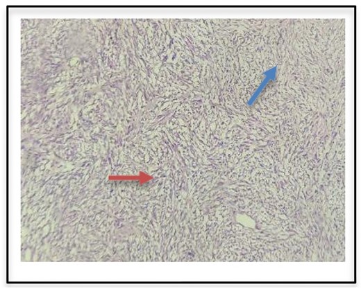 Histopathologic examination of surgical specimen indicates Antoni A (red arrow) and Antoni B bodies (blue arrow).