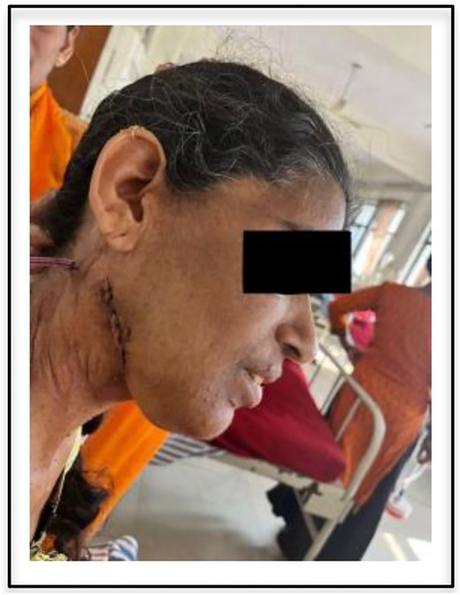 Postoperative view of incision site.