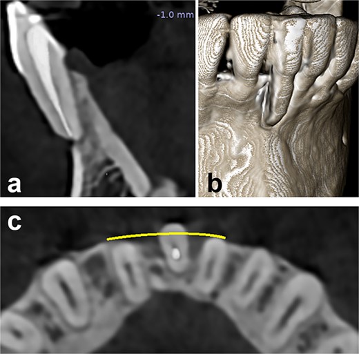 Preoperative radiographical status, (a) sagittal section, (b) 3D construction view, and (c) axial section.