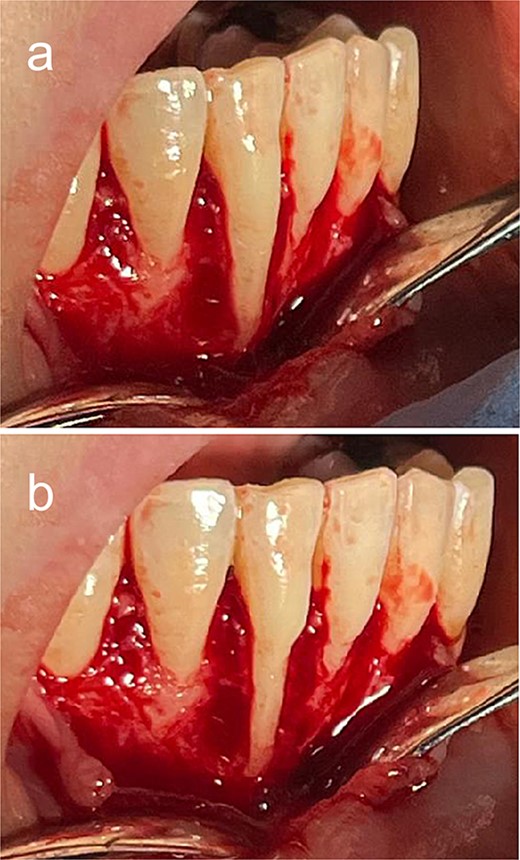 Intraoperative (a) preodontoplasty and (b) postodontoplasty.