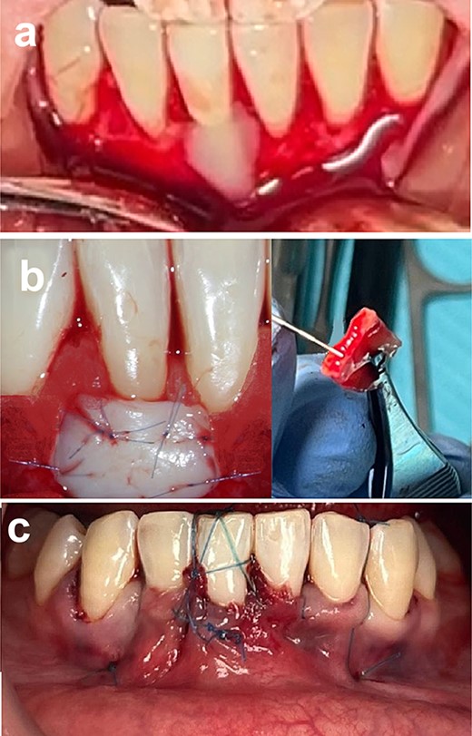 Connective tissue grafting (a) root surface biomodification, (b) connective tissue graft placement, and (c) suturing.