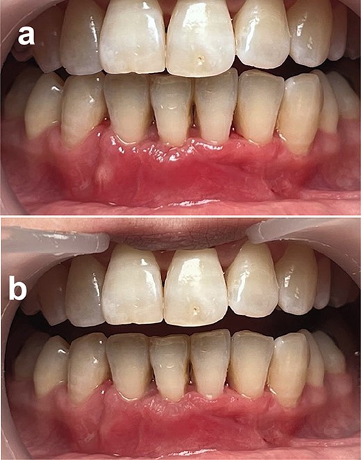 Postoperatively, (a) 2 weeks post-op and (b) 3 months post-op.