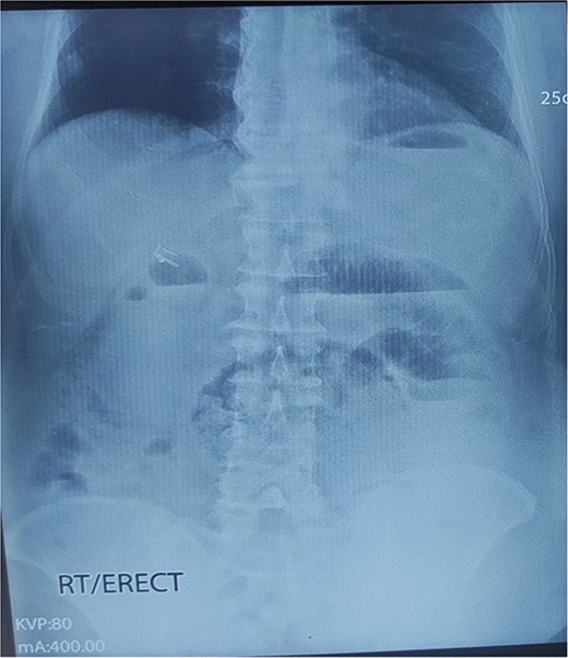 X-ray abdomen erect showing dilated small bowel loop with multiple air-fluid levels.