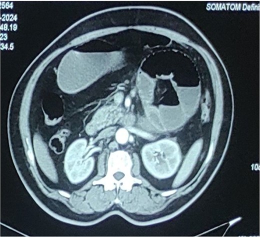 Computed tomography abdomen and pelvis showing distended multiple jejunal loops bunched together in the left upper quadrant with narrowing of both proximal and distal ends suggestive of closed loop obstruction (? Paraduodenal hernia).