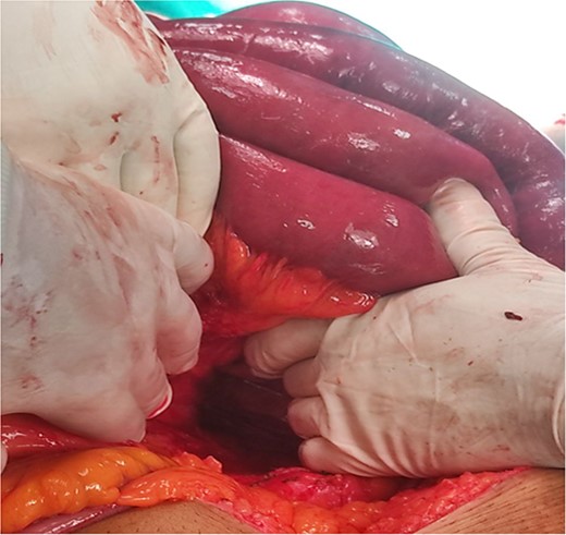 Intraoperative image showing reduced herniated jejunal loops and hernial defect.