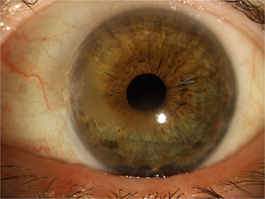 Slit-lamp examination showing gray horizontal opacity with paracentral and inferior involvement.