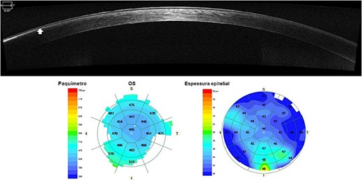 AS-OCT with epithelial map showing a thin nasal sub-epithelial hyper reflective band with posterior shadowing. A denser hyper reflective zone can be noticed at the periphery.