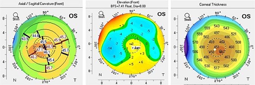 Scheimpflug imaging showing irregular astigmatism and superficial irregularity.