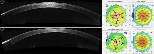 AS-OCT at 1-year postoperatively shows improvement of the paracentral hyper reflective band. A worsening in the peripheral untreated are can also be noticed. Scheimpflug imaging demonstrates thinning of central corneal thickness and reduction of mean anterior keratometry (45.3D) with superficial regularization.