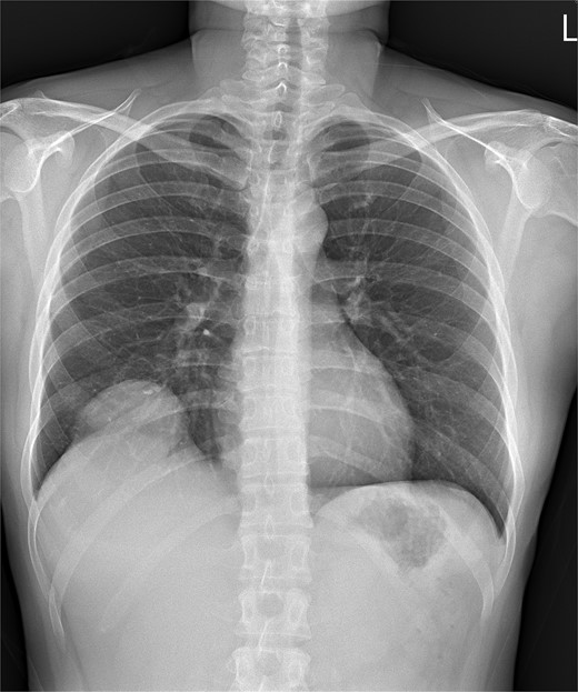 Chest X ray image of sarcomatoid cholangiocarcinoma with direct invasion into the diaphragm and lung.