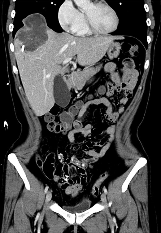 Coronal view of a CT image of sarcomatoid cholangiocarcinoma.