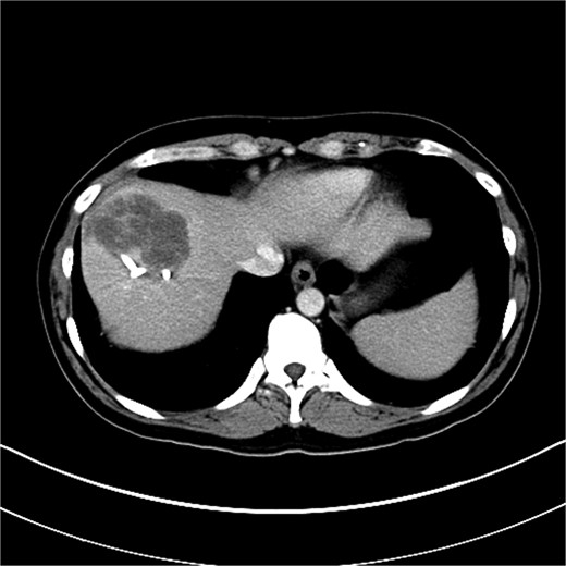 Axial view of CT image of abdomen.