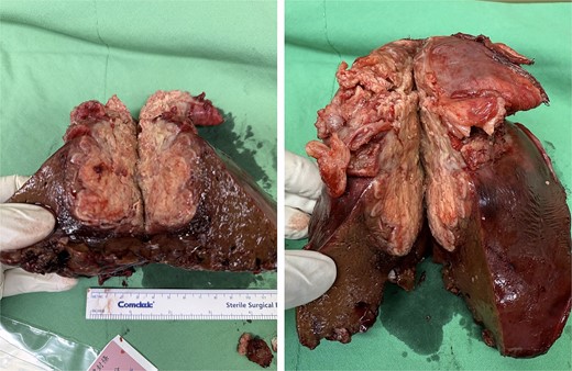 Specimen of sarcomatoid cholangiocarcinoma.