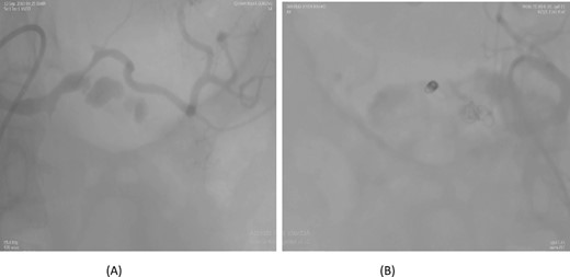 Case 1. (A) Angiogram pseudoaneurysm from splenic artery. (B) Angioembolization of splenic artery with coil