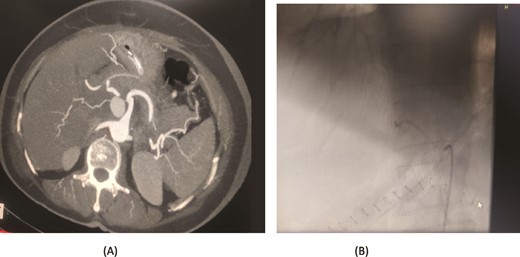Case 2. (A) CT angiogram showing pseudoaneurysm CHA. (B) Angioembolization of CHA with gel foam