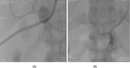 Case 3. (A) Angiogram shows pseudoaneurysm from proper hepatic artery. (B) Angioembolization of proper hepatic artery with coil.