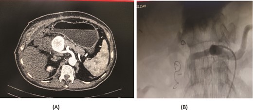 Case 4. (A) CT scan – pseudoaneurysm at bifurcation of gastroduodenal artery and proper hepatic artery. (B) Embolization of gastroduodenal artery and proper hepatic artery.