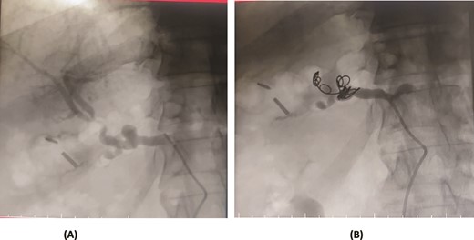 Case 5. (A) Angiogram shows a pseudoaneurysm at common hepatic artery and another at hepatic artery proper. (B) Common hepatic artery was selected and embolization performed with two coils and gelfoam