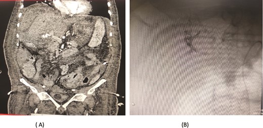 Case 6. (A) CT angiogram showing pseudoaneurysm and bleeding from right hepatic artery. (B) Embolization performed with coils.