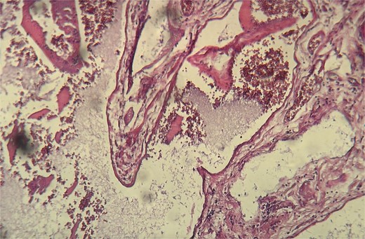 Histopathological examination showing ectatic blood vessels containing red blood cells.