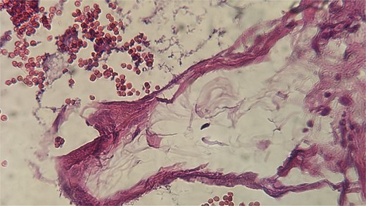 The vessels were lined by a single layer of regular endothelium.