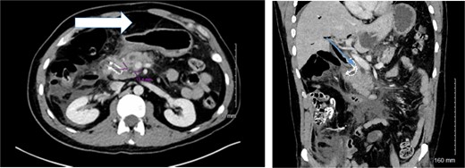 Preoperative and intraoperative findings of duodenal perforation and reconstruction. Preoperative CT- scan of the abdomen delineating the amount of free intra-peritoneal air (arrow) and the location of the biliary metallic stent (arrow).