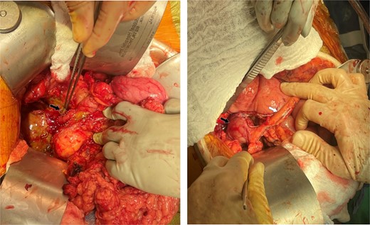 Intraoperative findings and final reconstruction using vascularized isolated distal gastric pouch. (A) Intraoperative findings of the duodenal perforation (dotted circle) and the metallic stent protruding through the bile duct (arrow). (B) Final reconstruction using vascularized isolated distal gastric pouch (black arrow) maintaining the gastroepiploic vascular pedicle to the pouch (arrow).