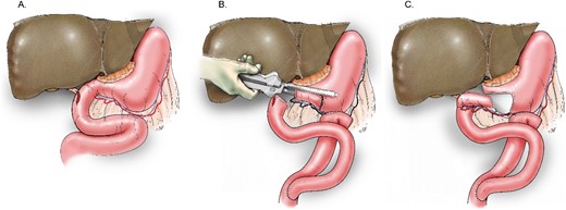 Schematic delineating the reconstruction technique for the vascularized, isolated gastric pouch. (A) Depiction of the site of the duodenal and bile duct injury. (B) Creation of the distal gastric pouch. (C) Final anastomoses of the pouch to the duodenal and bile duct defect.