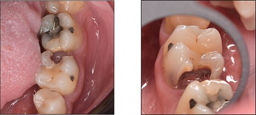 Clinical photograph of tooth 36 showing extensive caries on disto-occlusal surface.
