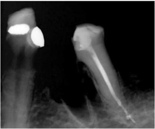 Immediate postoperative radiograph of the mesial segment of tooth 36 showing overhanging dentin at furcation area mesial to the remaining root.