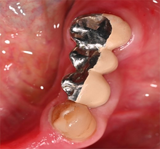 Clinical photographs showing the occlusal view of milled PBM bridge 35-P-36 after cementation.