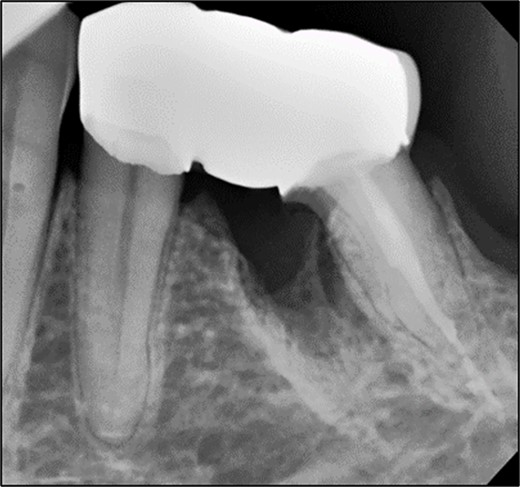 Periapical radiograph post-cementation of bridge 35–36 showing good adaptation of restorative margins and healing of bony lesion.