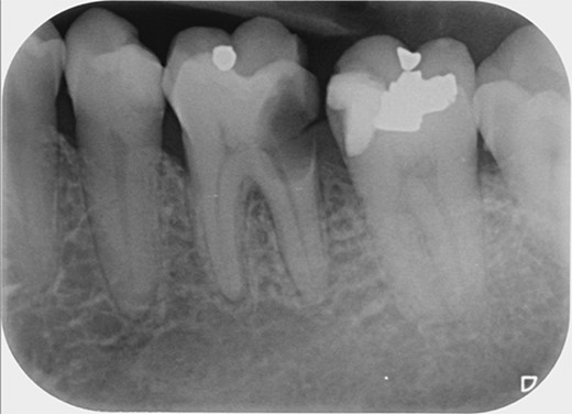 Periapical radiograph of tooth 36 showing a large radiolucency area at the distal crown involving the cervical third of the distal root.