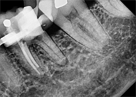 Periapical radiograph of tooth 36 with obturation on MB and ML canals.