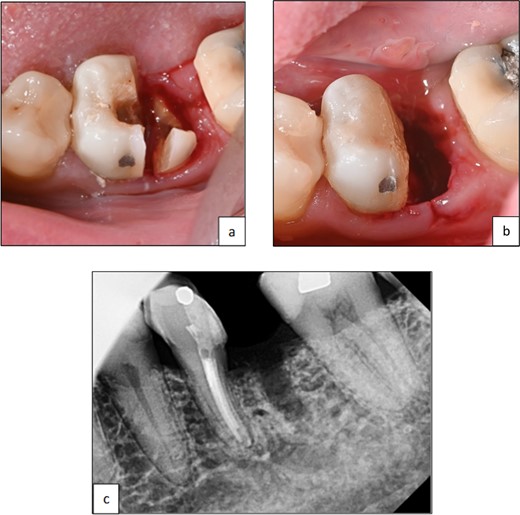 Clinical photographs showing (a) line of resection through furcation area and separation of mesial and distal roots, (b) after elevation of root and smoothening of sharp edges, (c) periapical radiograph of tooth 36 after hemisection and removal of distal root.