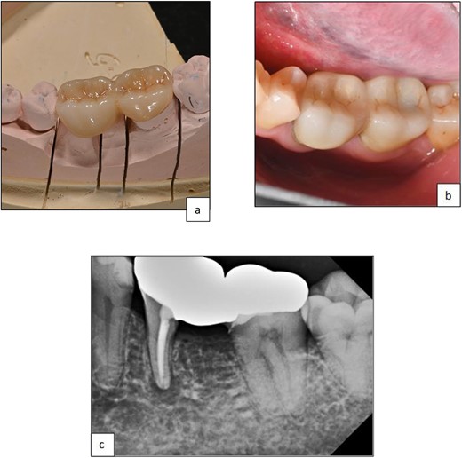 Clinical photographs showing (a) zirconia bridge design, (b) final prosthesis after cementation, (c) periapical radiograph post-cementation of zirconia, the bridge shows a good adaptation of the restorative margins.