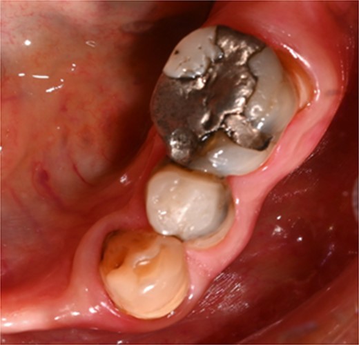 Clinical photograph of tooth 36 showing extensive amalgam restoration on mesio-occlusal-disto-bucco-lingual (MODBL).