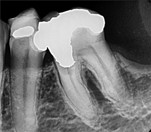 Periapical radiograph of tooth 36 shows large radiopacity, indicating a restoration on the crown extending to the mesial root surface. Radiolucency was detected beneath restoration on the mesial root surface, indicating caries. Peri-radicular radiolucency was observed in the furcation region.