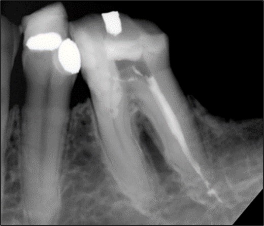 Periapical radiograph of tooth 36 with obturation on DB and DL canal. Sealer extrusion noted.
